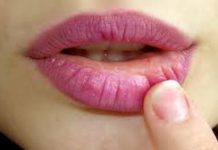 Causes and Natural Tips to Cure Big Bump on Lip line – water blister on lip Bump on Lip