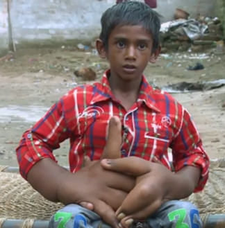 What is lymphangioma tumor | lymphatic malformation in adults -lymphangioma lymphangioma