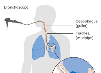 Definition, symptoms, causes and Treatment for Mesothelioma pain in side -mesothelioma definition mesothelioma definition